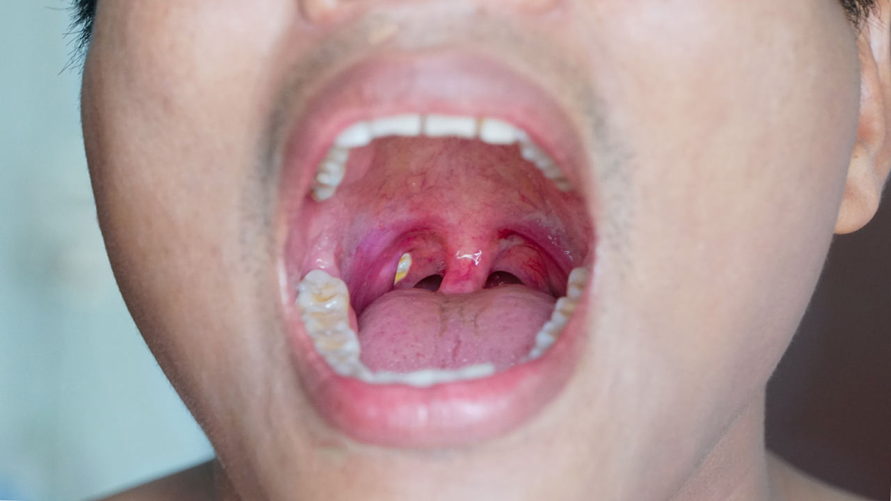 How To Treat Tonsil Stones