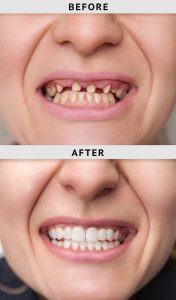 Advantages Of Cosmetic Dentistry Before And After