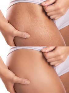 Surgery For Stretch Marks