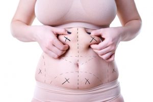 Stomach Liposuction
