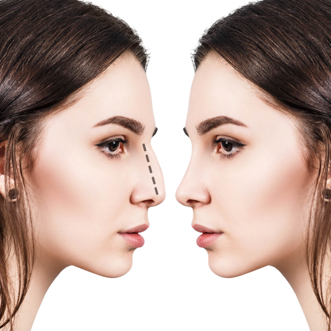 nose job transformations
