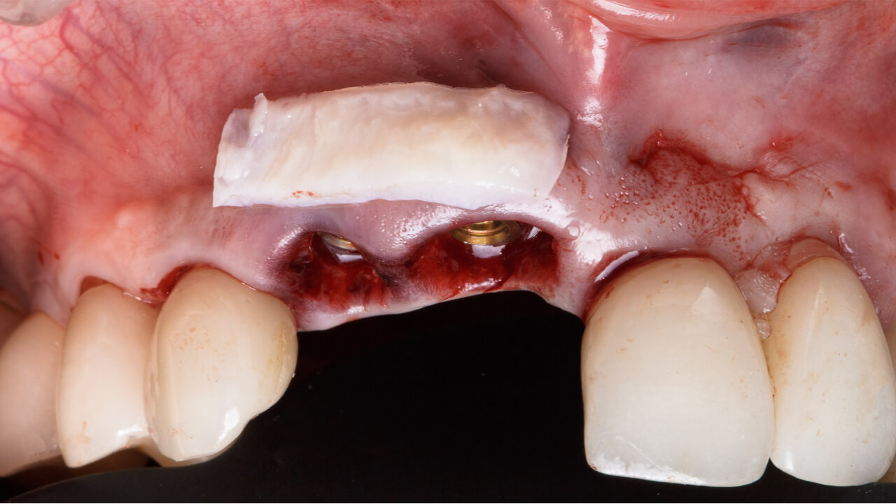 gingival flap surgery