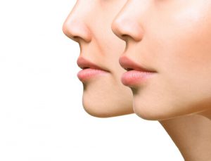 lip augmentation fat transfer