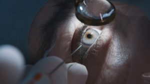 long term side effects of laser eye surgery procedure