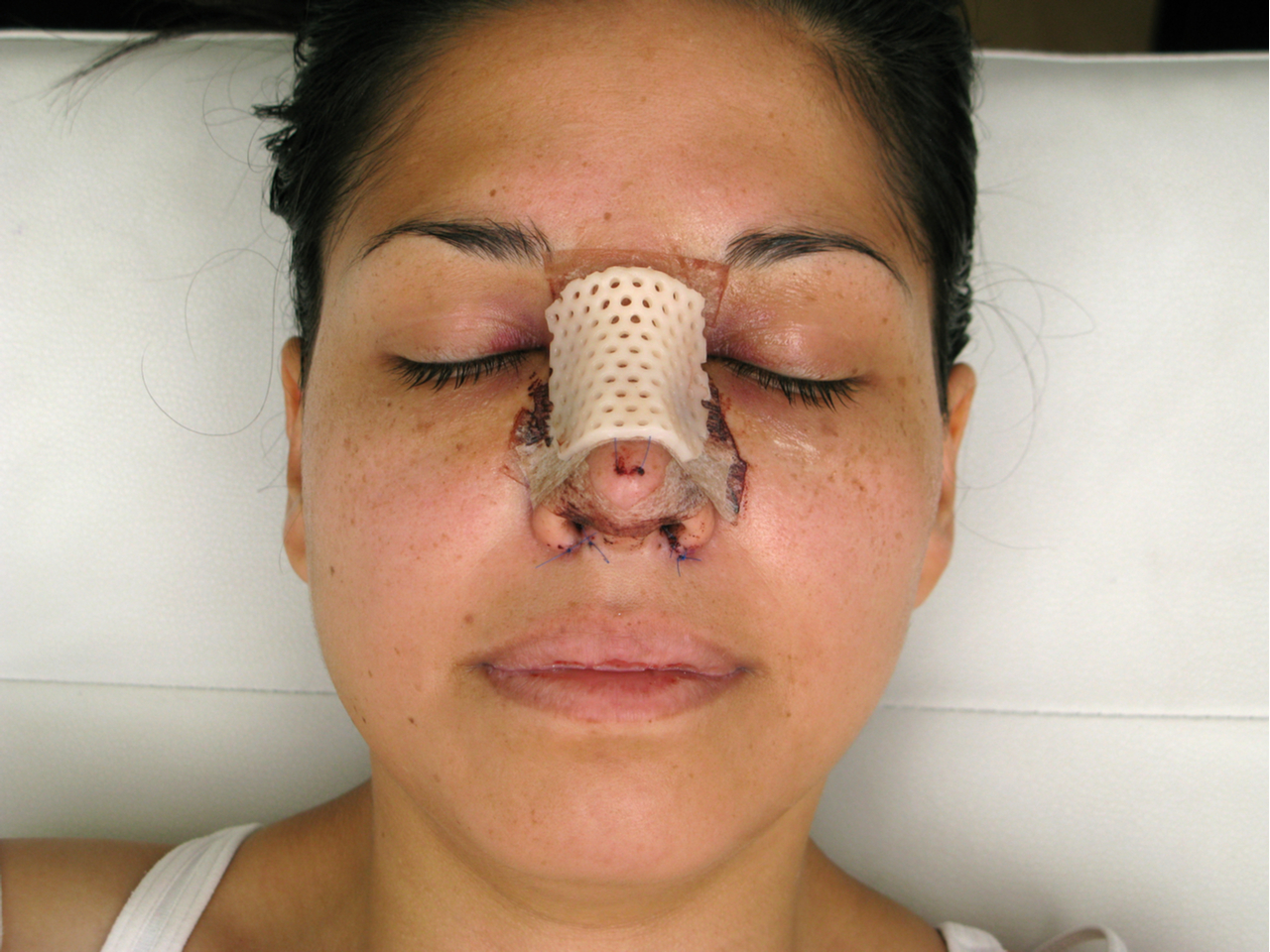 woman with bandage wondering if her plastic surgery fails