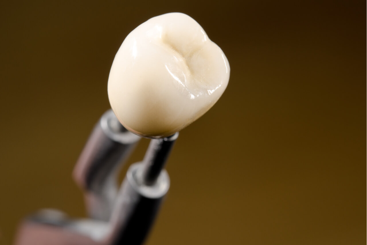 dental crown vs veneer